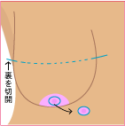 乳房下縁を大きく横に切り、乳輪は一旦体から小さめに切り離す